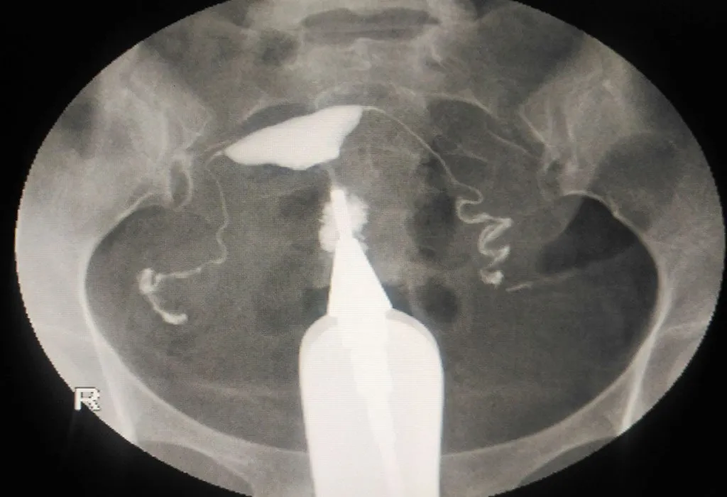 Ultrasound image of anteverted uterus