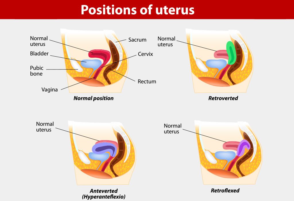 Anteverted uterus