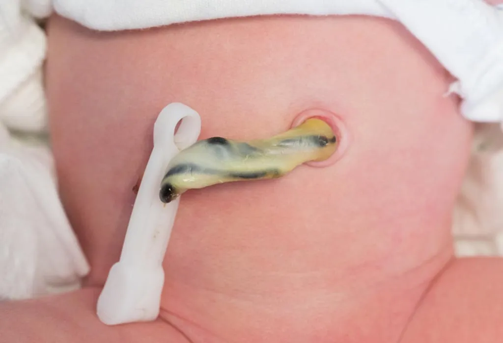 Risks Involved With Lotus Birth