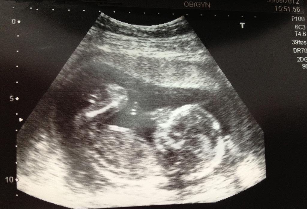 An ultrasound scan at 4 months