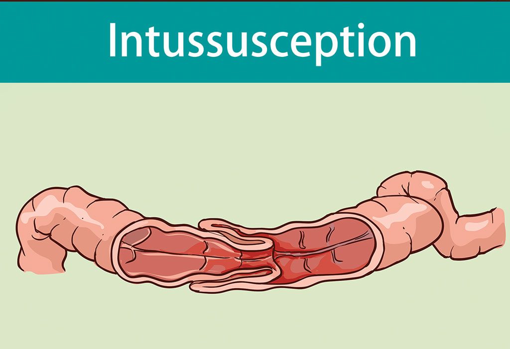 Intussusception