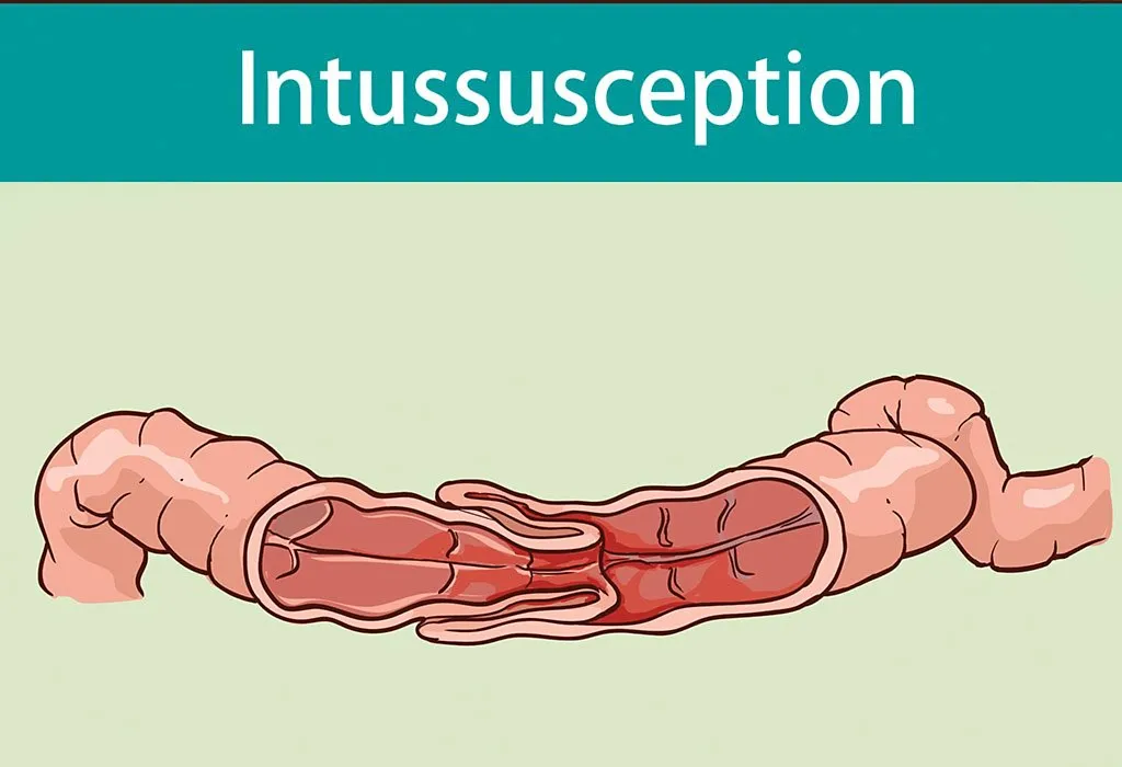 intussusception in children