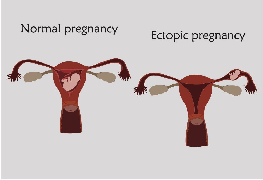  ECTOPIC PREGNANCY