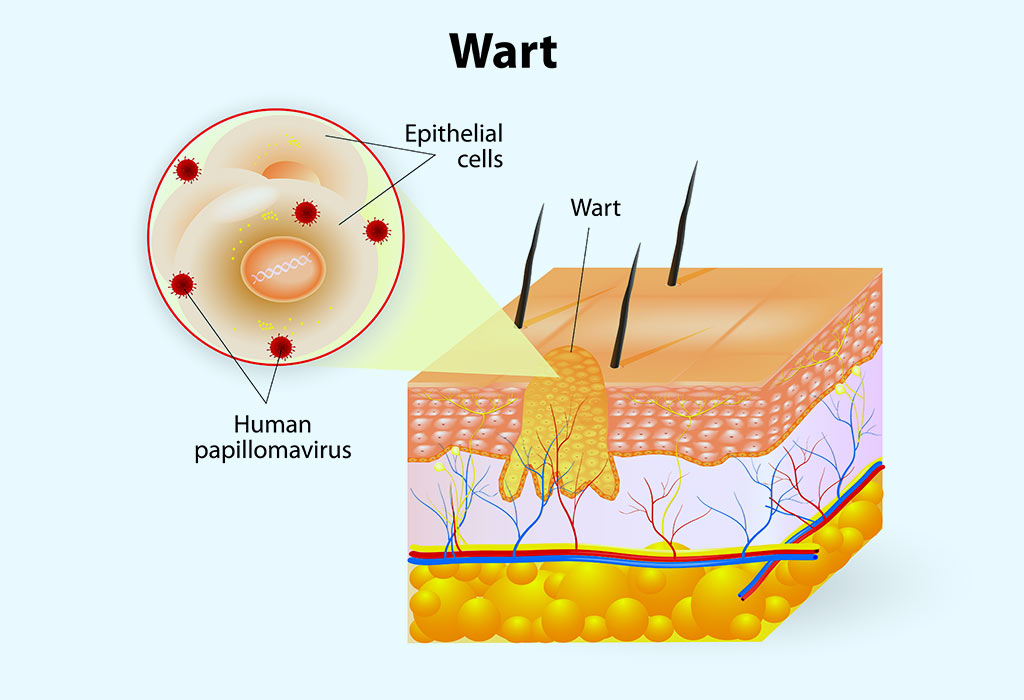 Warts in your mouth