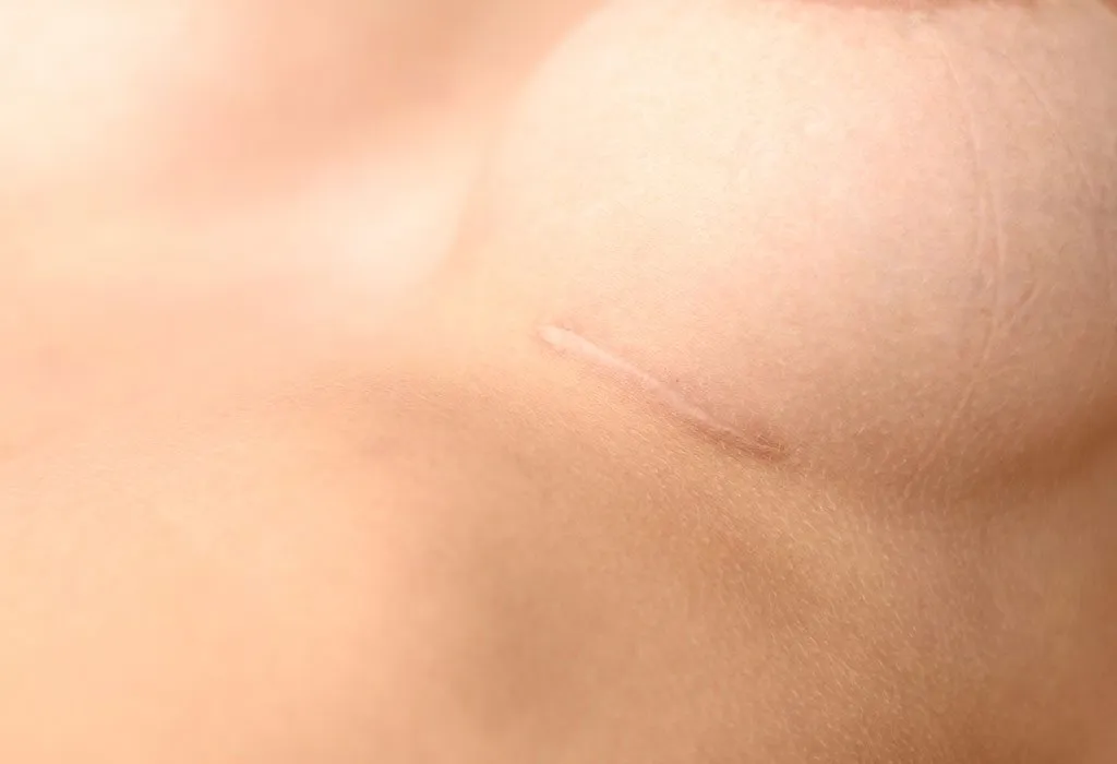 Breast implant scar