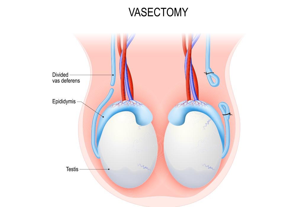 Diagrammatic representation of vasectomy