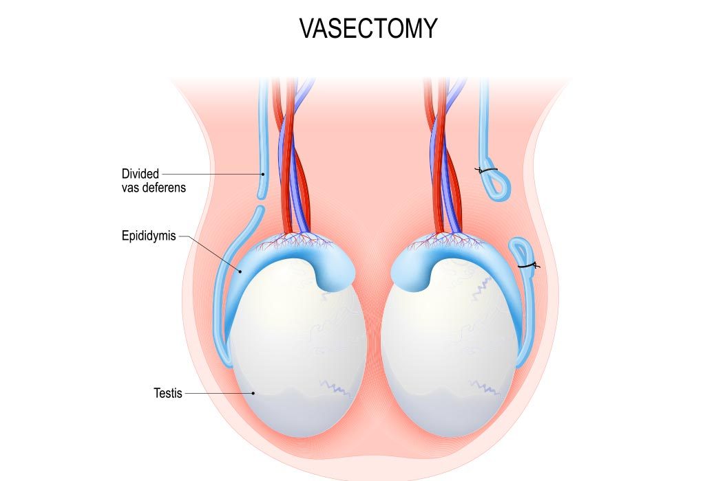 Impact of reversal of vasectomy in sperm