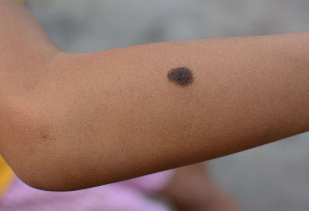 Moles On Childs Body Signs And Prevention Tips