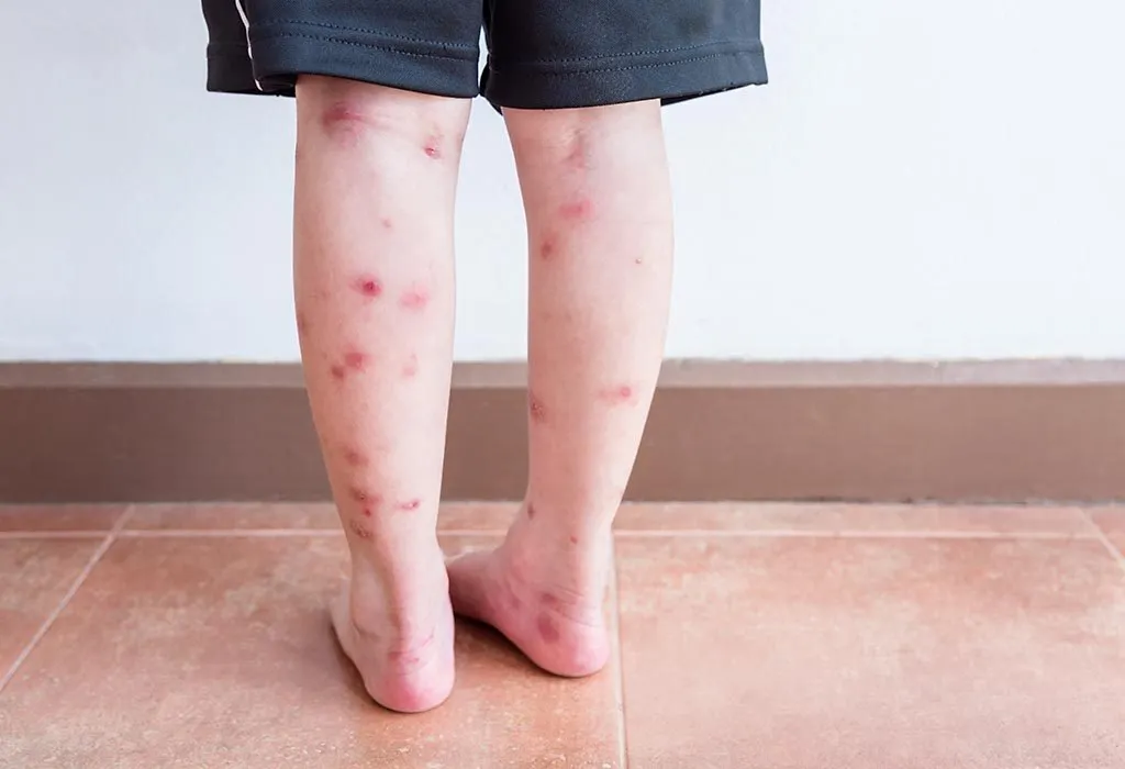 A child with scars on his legs
