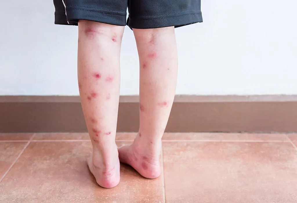 Scars in Children: Causes, Treatment, Prevention & Home Remedies