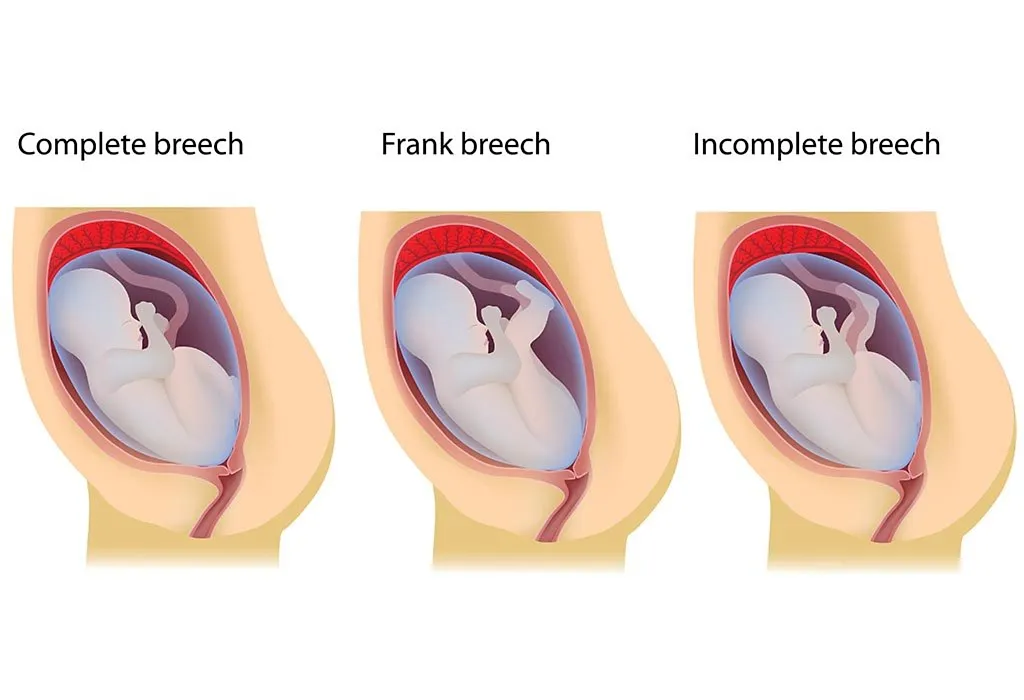 A baby in a breech position