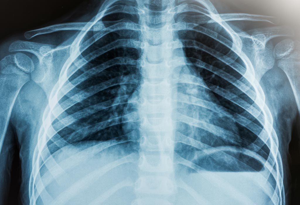 CHEST X-RAY