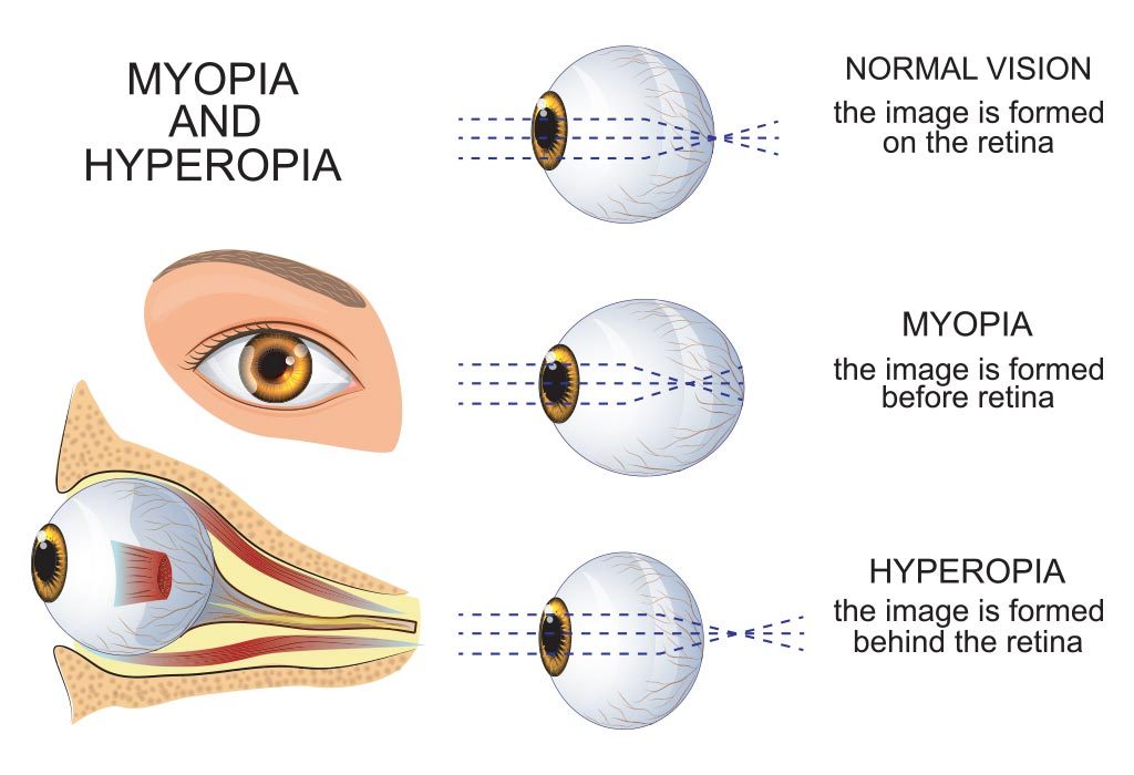 Myopia & Hyperopia