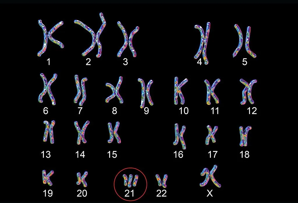 Karyotype of person with Down Syndrome