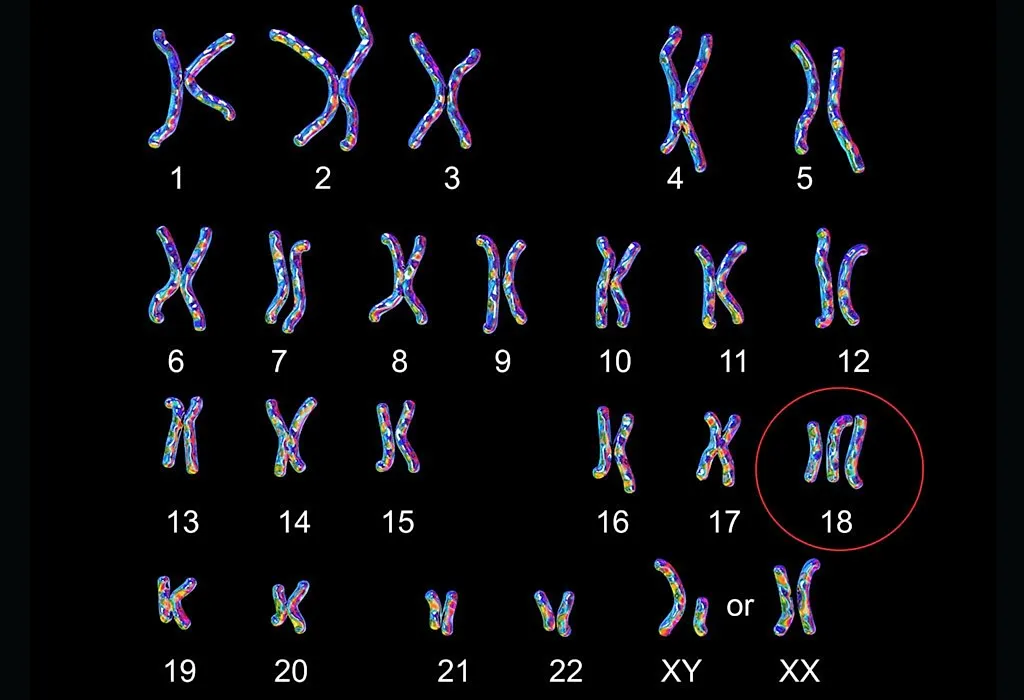 Karyotype of person with Edwards Syndrome