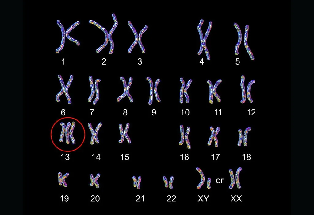 Karyotype of person with Patau Syndrome