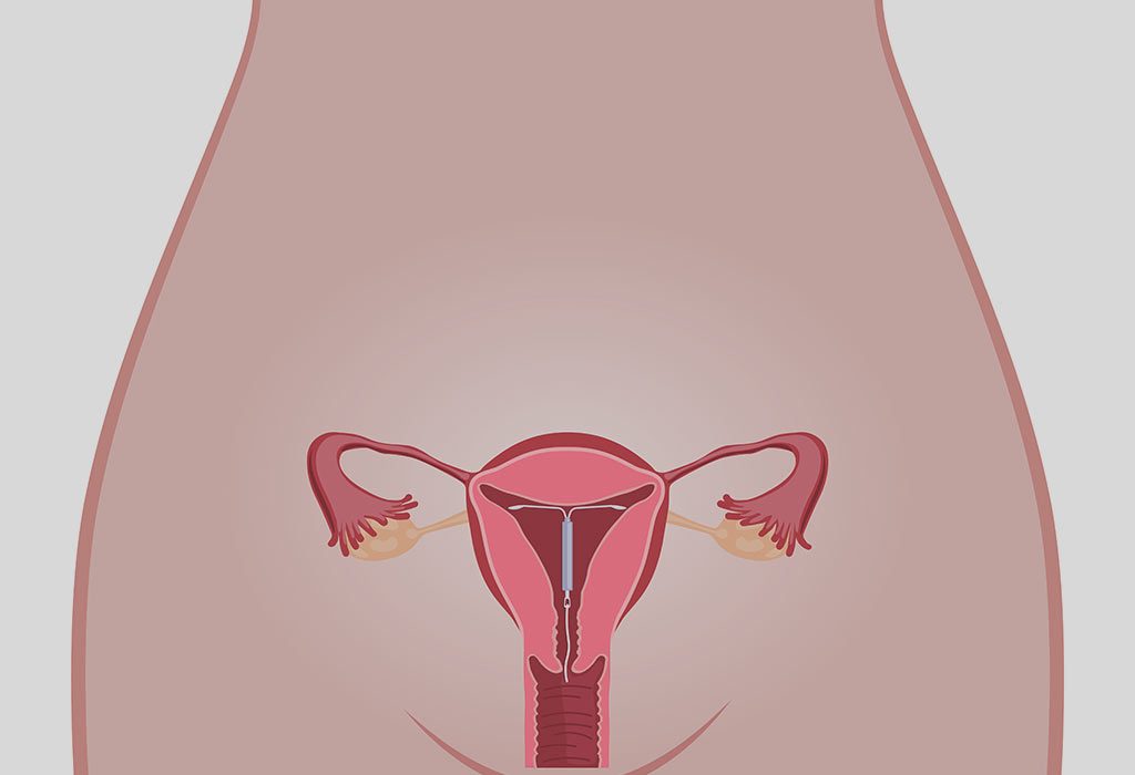 Can You Get Pregnant After Iud Removal Before Period Pregnancy After Iud Removal Is It Possible