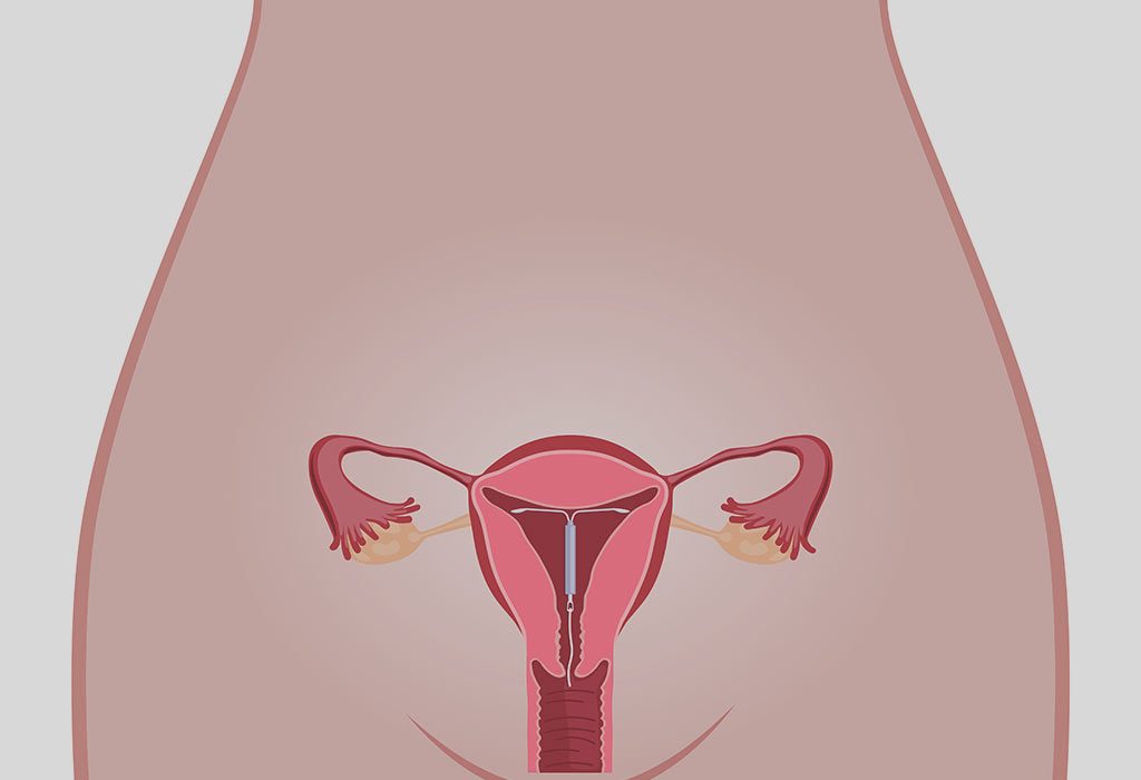 Pregnancy After Iud Removal Is It Possible