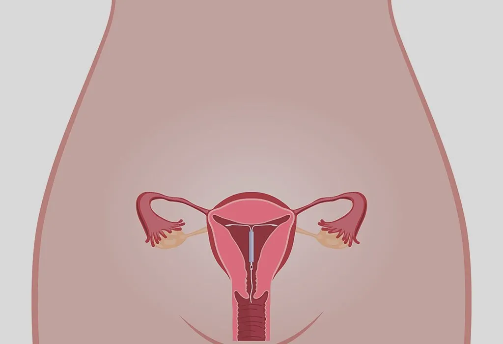 IUD in a woman's uterus