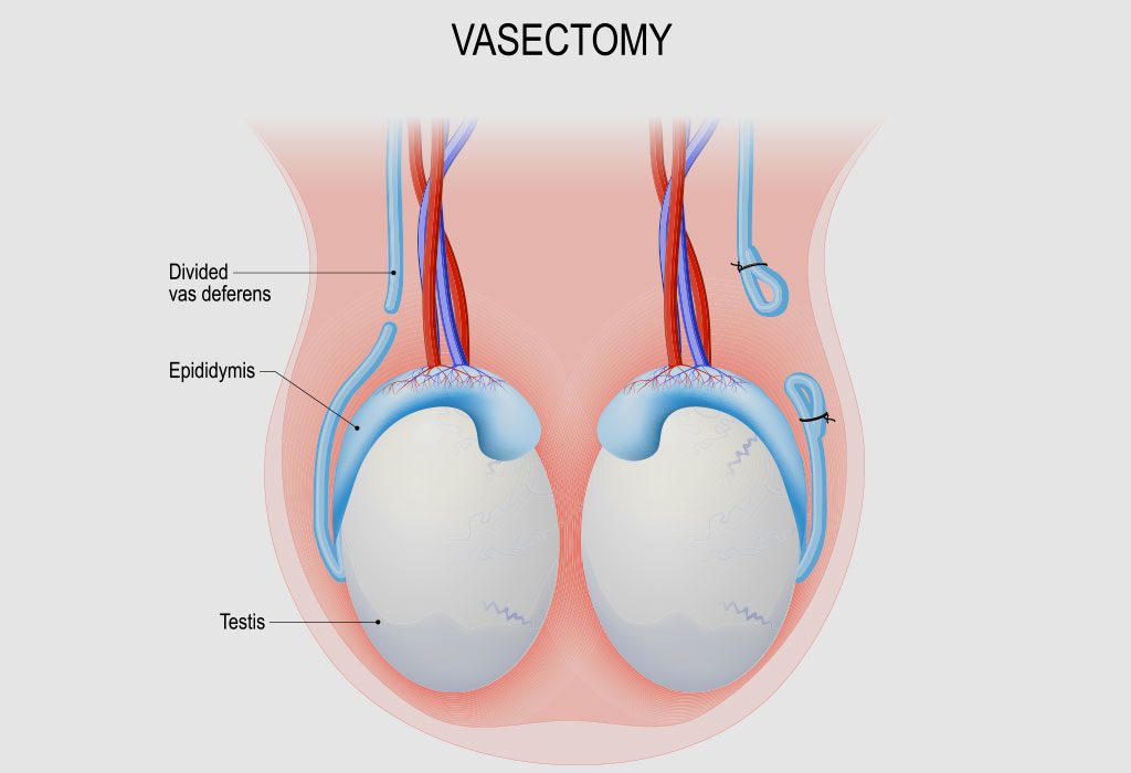 Is It Possible To Get Pregnant After Vasectomy