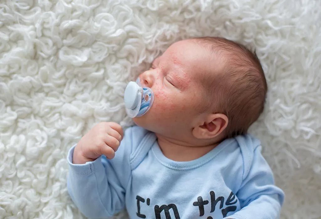 BABY ACNE