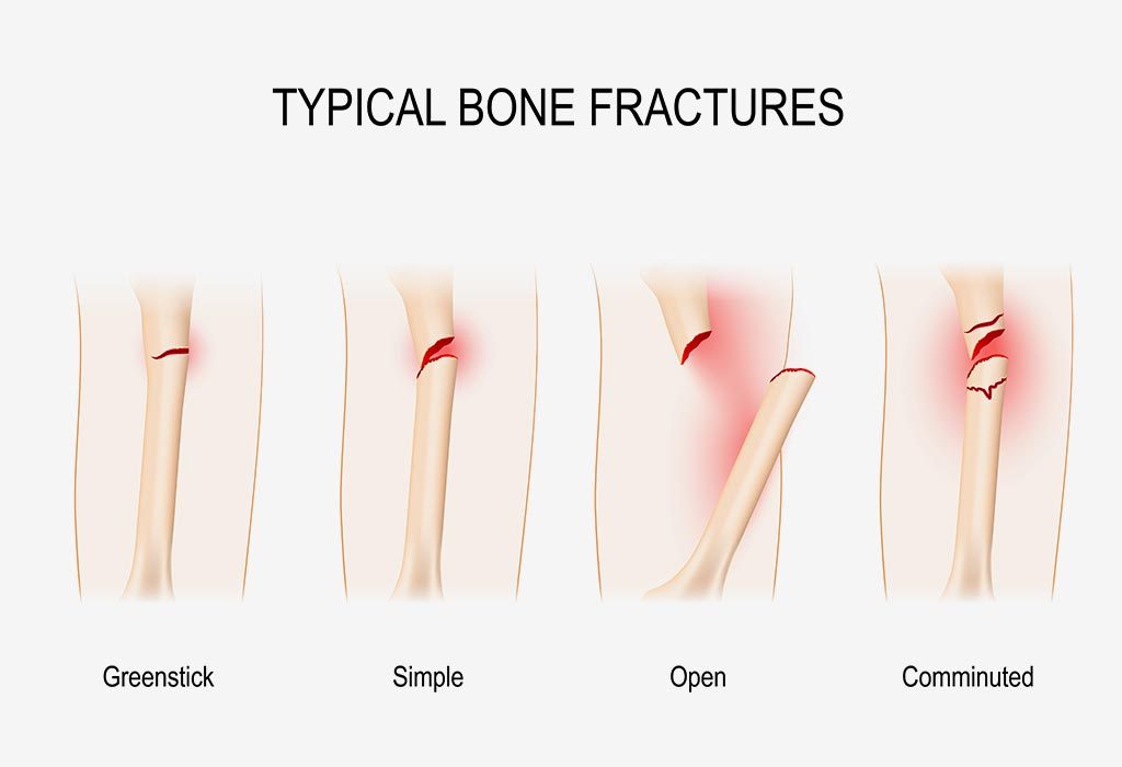 Common types of bone fractures in children