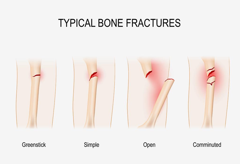 बच्चों में हड्डी के फ्रैक्चर के सामान्य प्रकार