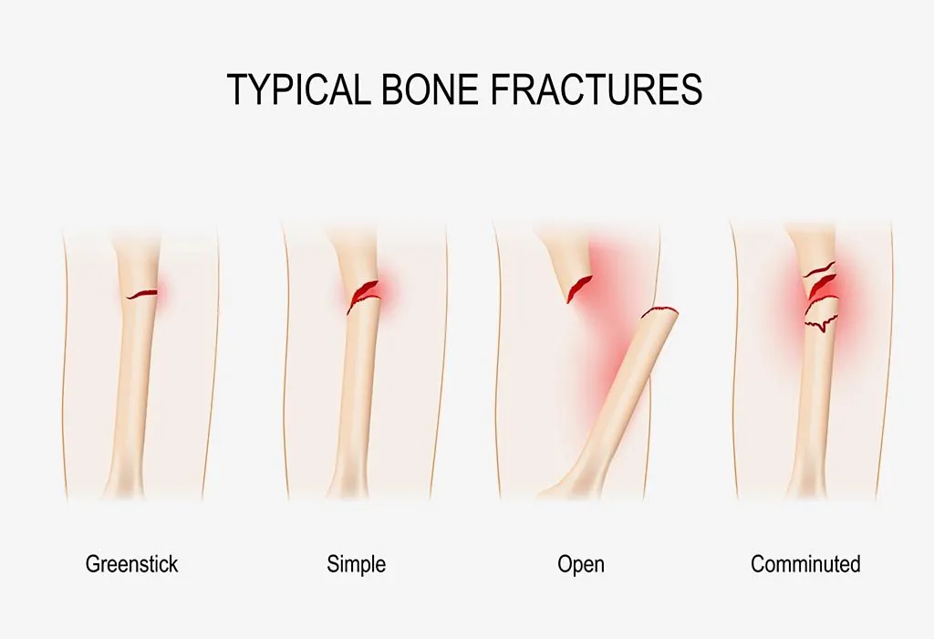 TYPES OF FRACTURE