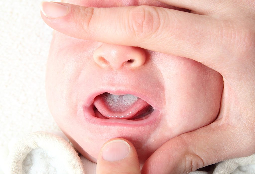 Oral Thrush in Babies
