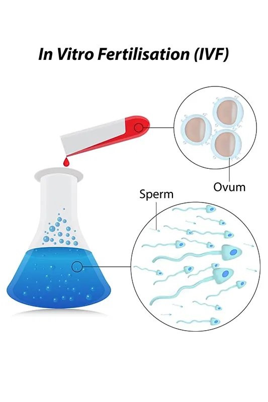 IVF