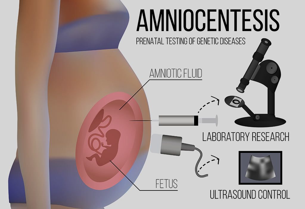 Amniocentesis test
