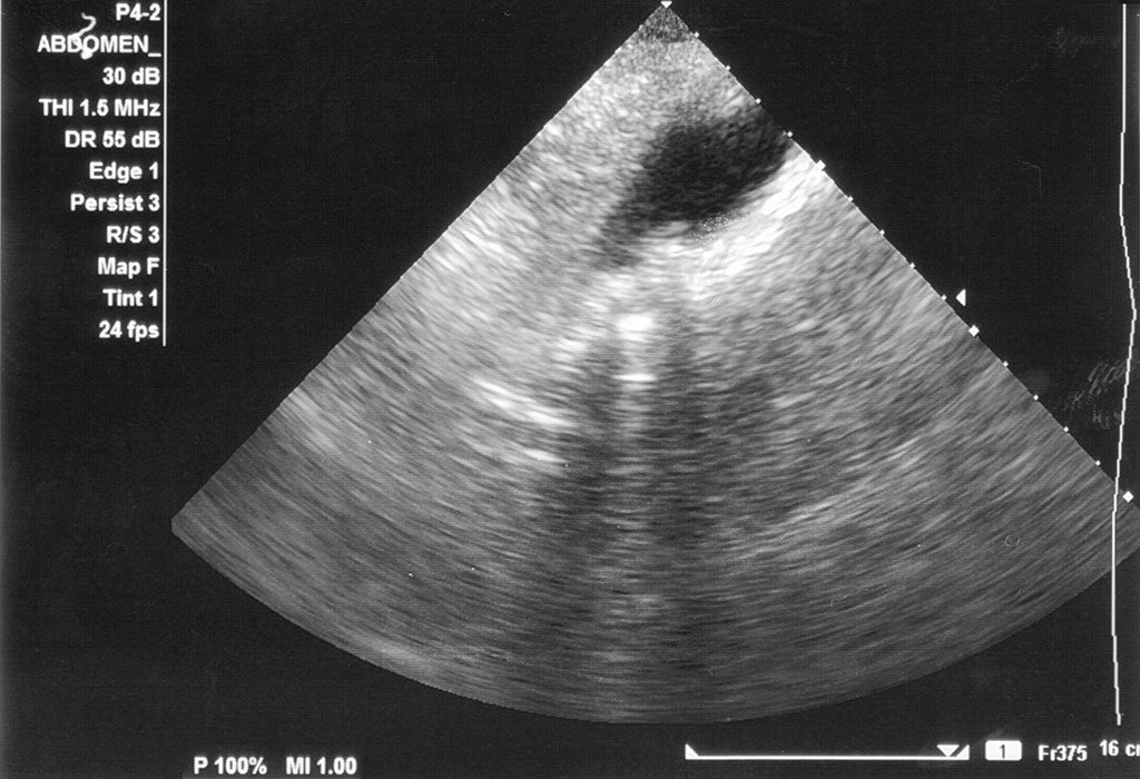 Ultrasound to detect gallstones