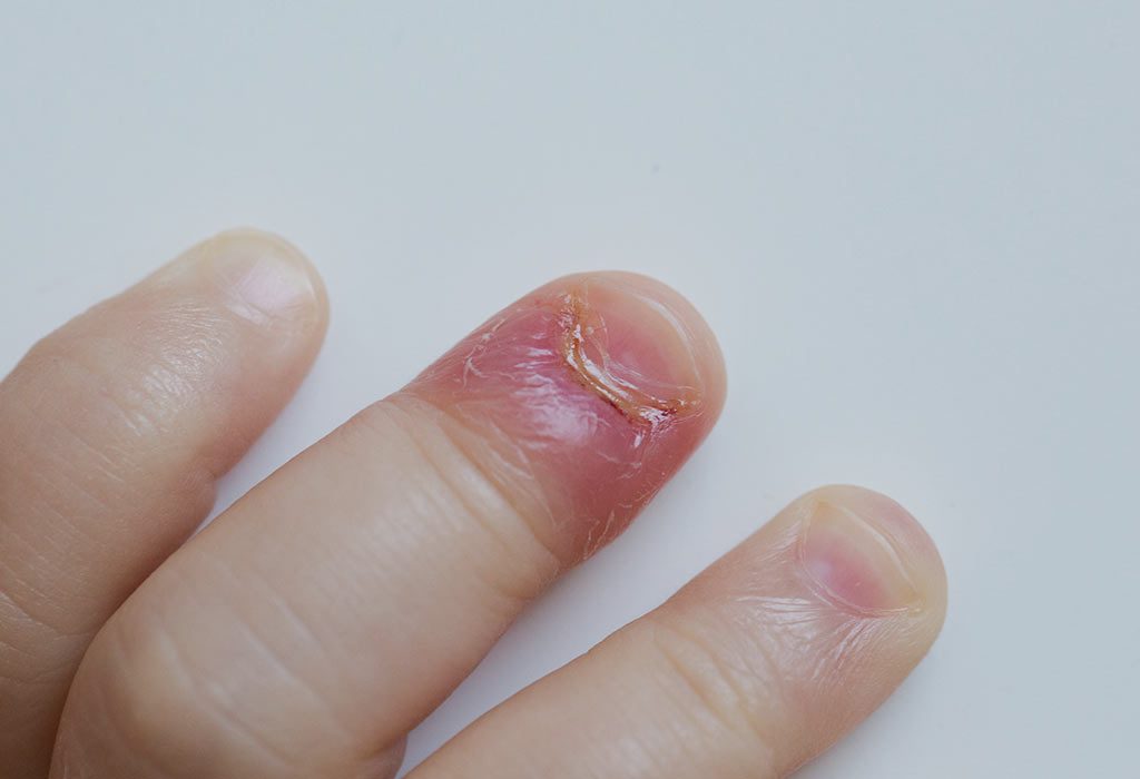 Infection on a child's nail