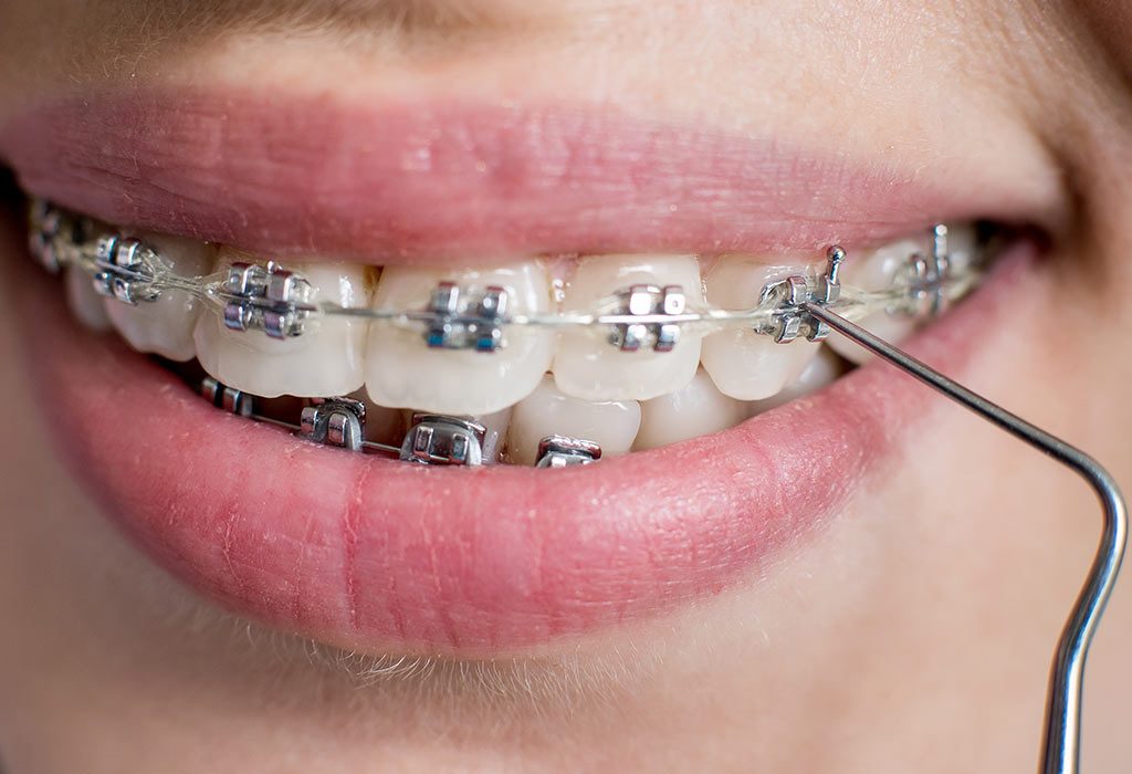 Traditional Braces