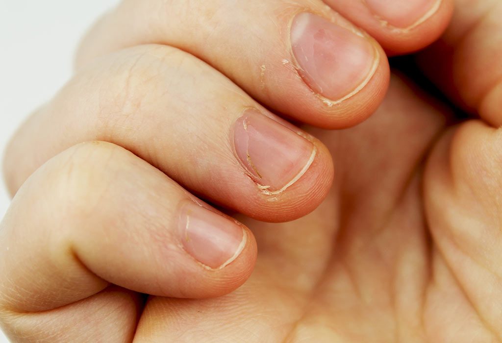 What Are White Spots On Fingernails Caused By