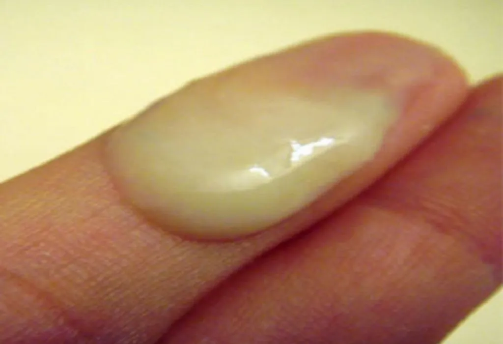 Egg White Cervical Mucus (EWCM): Appearance and Meaning