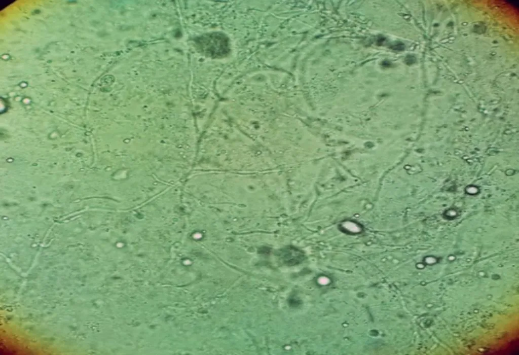 Disease or Infection