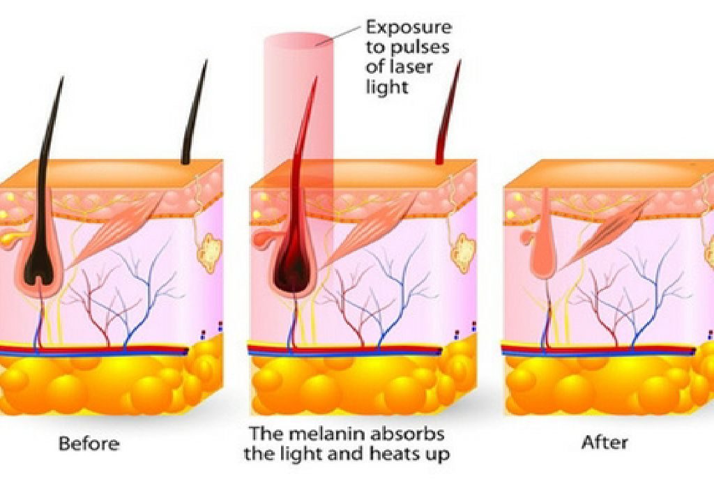 Laser Hair Removal Austin Cost Haircut HairStyle 2022