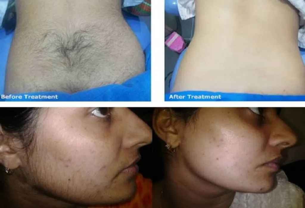 Laser Hair Removal – Before and After