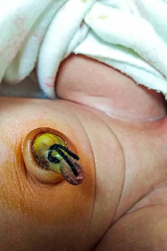 Signs of Umbilical Cord Infection