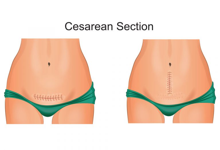 सी-सेक्शन करताना गर्भाशयाला घेतलेले जाणारे दोन प्रकारचे छेद
