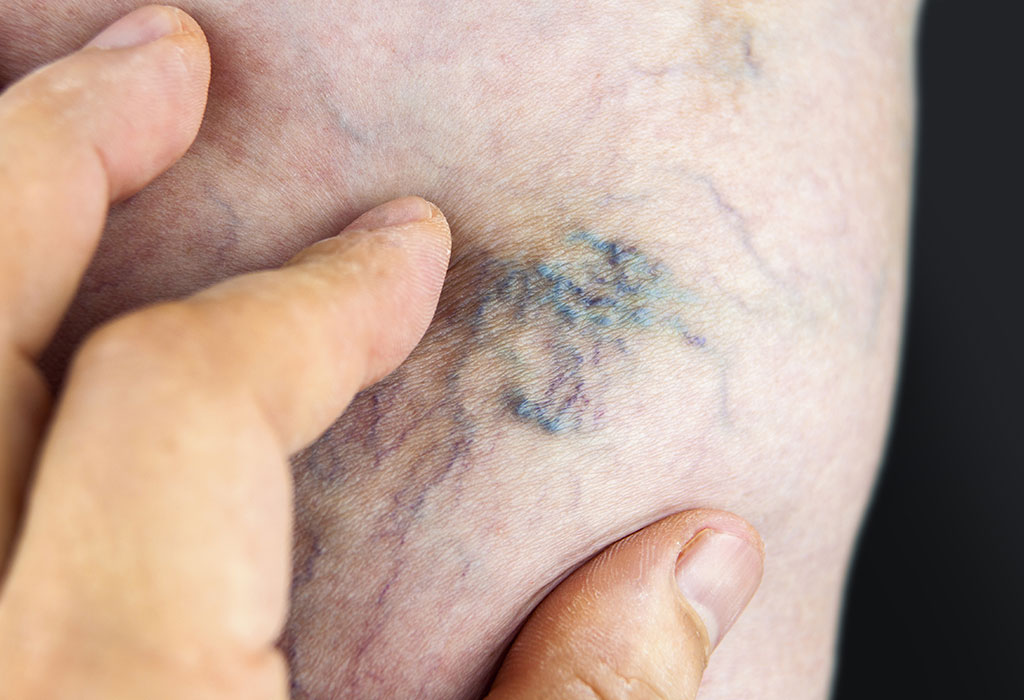 What are Varicose Veins? What are Varicose Veins?