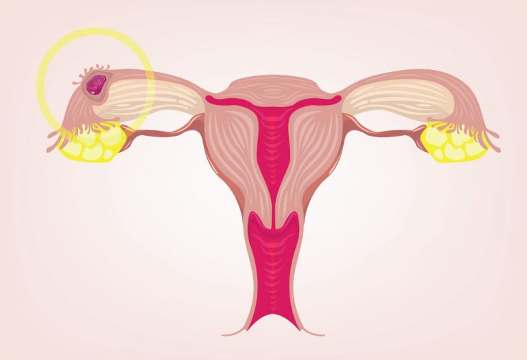 Ectopic Pregnancy - Reasons, Symptoms and treatment