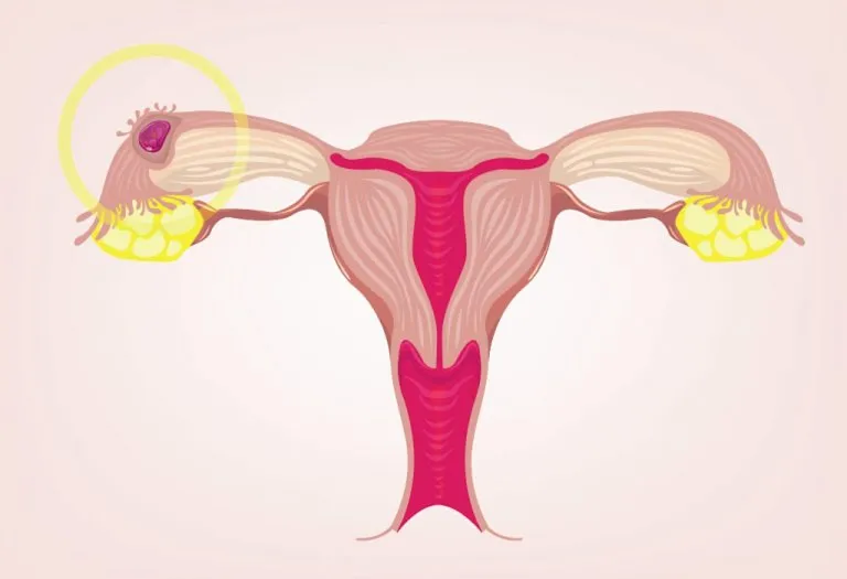 Ectopic Pregnancy - Reasons, Symptoms and treatment