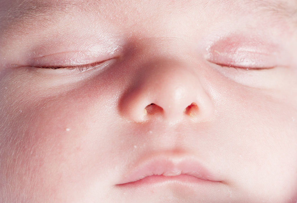新生児と乳児の稗粒腫 理由、兆候、家庭での対処法 NCGo