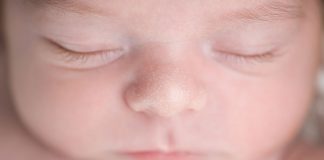 न्यूबॉर्न और छोटे बच्चों में मिलिया होना – प्रकार, कारण और उपचार न्यूबॉर्न और छोटे बच्चों में मिलिया होना - प्रकार, कारण और उपचार