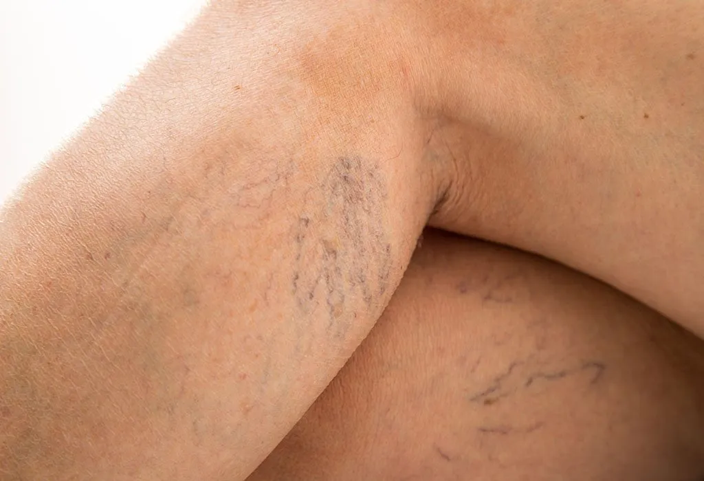 Varicose Veins While Pregnant - Symptoms, Causes & Treatment