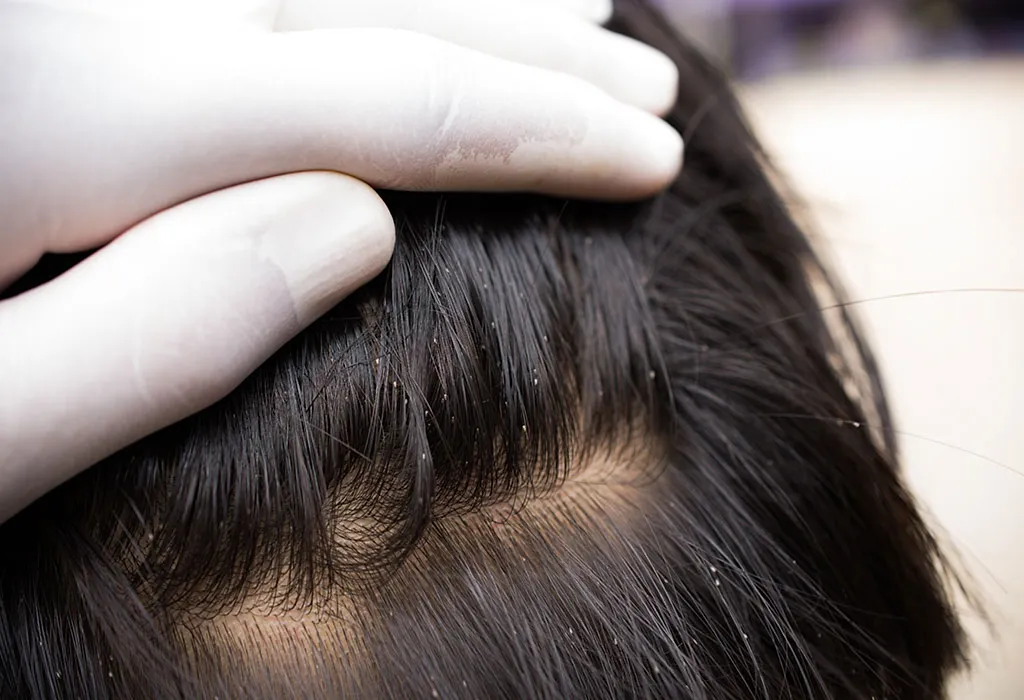 Details more than 80 causes of hair lice best - in.eteachers