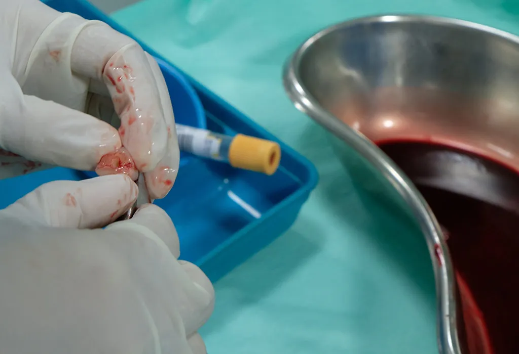 How Is Umbilical Cord Blood Collected and Processed?