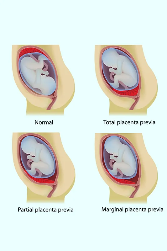 प्लॅसेंटा प्रेव्हियाचे वेगवेगळे प्रकार कुठले आहेत?